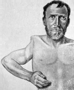 Fig. 103.—Arthropathy of Shoulder in Syringomyelia.
The upper end of the humerus has disappeared and the movements are
flail-like (cf. Fig. 104).