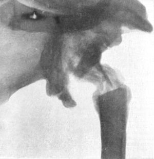 Fig. 104.—Radiogram of specimen of Arthropathy of
Shoulder in Syringomyelia. The head of the humerus has disappeared and
masses of new bone have formed in the surrounding muscles (cf. Fig.
103).