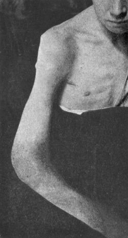 Fig. 106.—Diffuse Tuberculous Thickening of Synovial
Membrane of Elbow (white swelling) in a boy æt. 12.