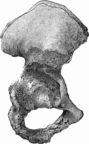 Fig. 108.—Advanced Tuberculous Disease of Acetabulum
with caries and perforation into pelvis.
