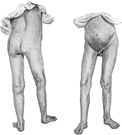 Fig. 109.—Early Tuberculous Disease of Right Hip-joint
in a boy æt. 14, showing flexion, abduction, and apparent lengthening
of the limb.