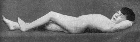 Fig. 110.—Disease of Left Hip: position of ease
assumed by patient, showing moderate flexion and lordosis.