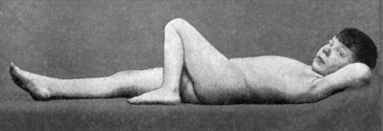 Fig. 111.—Disease of Left Hip: disappearance of
lordosis on further flexion of the hip.