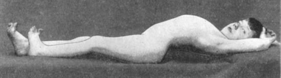 Fig. 112.—Disease of Left Hip: exaggeration of
lordosis produced by extending the limb.
