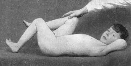 Fig. 113.—Thomas' Flexion Test, showing angle of
flexion at diseased (left) hip.