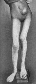 Fig. 115.—Advanced Tuberculous Disease of Left
Hip-joint in a girl æt. 14, showing flexion, adduction, shortening,
and iliac abscess.