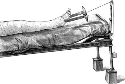 Fig. 116.—Extension by adhesive plaster and Weight and
Pulley.