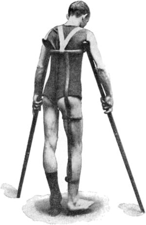 Fig. 118.—Thomas' Hip Splint applied for disease of
Right Hip. Note patten under sound foot. The foot on the affected side
is too near the ground.