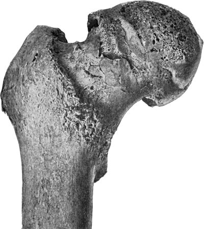 Fig. 119.—Arthritis Deformans, showing erosion of
cartilage and lipping of articular edge of head of femur.