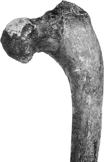 Fig. 120.—Upper End of Femur in advanced Arthritis
Deformans of Hip. The shaft is curved and the head of the bone is at a
lower level than the great trochanter.
