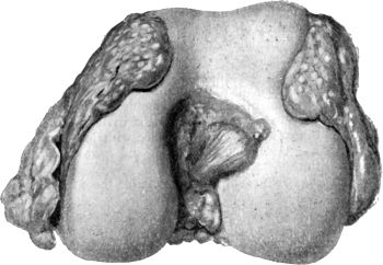 Fig. 122.—Tuberculous Synovial Membrane of Knee,
spreading over articular surface of femur.