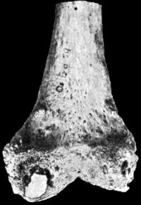 Fig. 123.—Lower End of Femur from an advanced case of
Tuberculous Arthritis of the Knee. Towards the posterior aspect of the
medial condyle there is a wedge-shaped sequestrum, of which the
surface exposed to the joint is polished like porcelain.