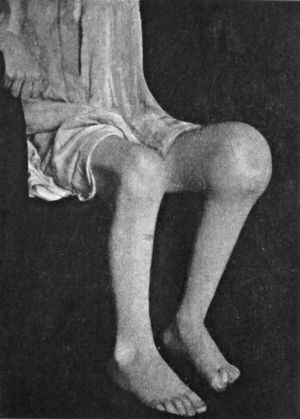 Fig. 124.—Advanced Tuberculous Disease of Knee, with
backward displacement of Tibia.