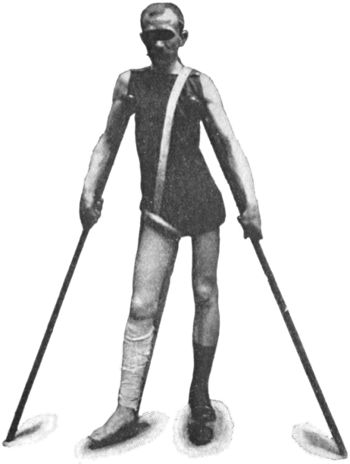 Fig. 125.—Thomas' Knee Splint applied. Note extension
strapping applied to affected leg, and patten under sound foot.