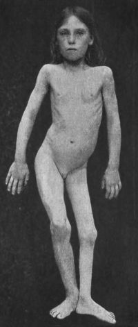 Fig. 127.—Female child showing the results of
Poliomyelitis affecting the left lower extremity; the limb is short
and poorly developed, the pelvis is tilted and the spine is curved.