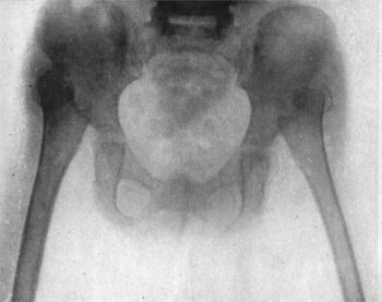 Fig. 128.—Radiogram of Double Congenital Dislocation
of Hip in a girl æt. 4.