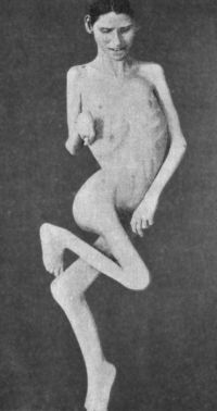 Fig. 131.—Contracture Deformities of Upper and Lower
Limbs resulting from Spastic Cerebral Palsy in infancy.