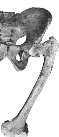 Fig. 133.—Coxa Vara, showing adduction curvature of
neck of femur associated with arthritis of the hip and knee.
