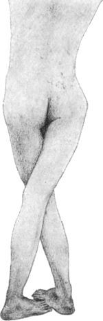 Fig. 134.—Bilateral Coxa Vara, showing scissors-leg
deformity.