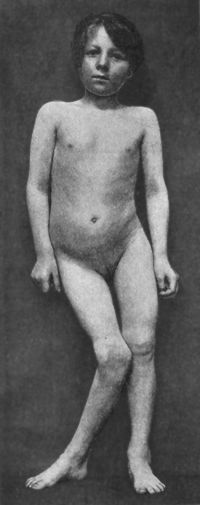 Fig. 136.—Female child with right-sided Genu Valgum,
the result of Rickets. The pelvis is tilted, and the spine is curved.