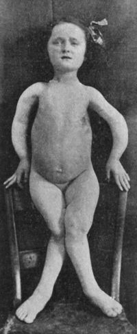 Fig. 137.—Female child with Rickety deformities of
upper and lower extremities.