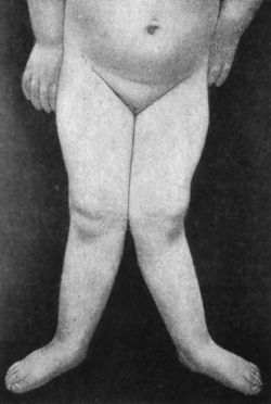 Fig. 139.—Genu Valgum in a child æt. 4. Patient
standing.