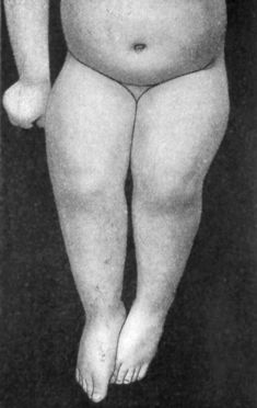 Fig. 140.—Genu Valgum. Same patient as Fig. 139.
Sitting, to show disappearance of deformity on flexion of knee.