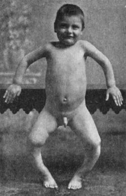 Fig. 141.—Bow-knee in Rickety Child.