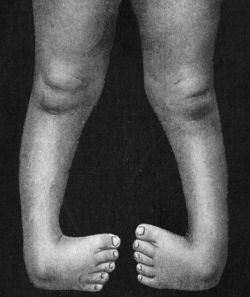 Fig. 142.—Bilateral Congenital Club-foot in an
infant.