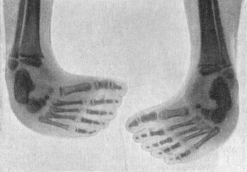 Fig. 143.—Radiogram of Bilateral Congenital Club-foot
in an infant.