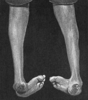 Fig. 144.—Congenital Talipes Equino-varus in a man æt.
24; seen from behind.