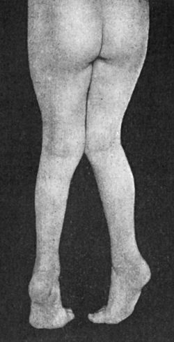 Fig. 145.—Bilateral Pes Equinus in a boy æt. 7, the
result of Spastic Paralysis.