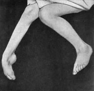 Fig. 146.—Extreme form of Pes Equinus in a girl æt. 8,
the result of Anterior Poliomyelitis.