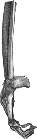 Fig. 147.—Skeleton of Foot from case of Pes Equinus
due to Poliomyelitis.