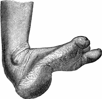 Fig. 148.—Pes Calcaneo-valgus with excessive arching
of foot.