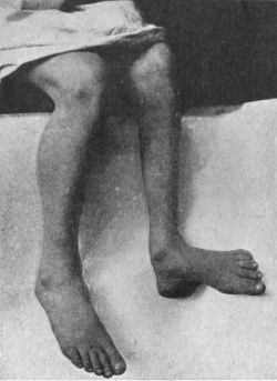 Fig. 149.—Pes Calcaneo-valgus, the result of
Poliomyelitis.