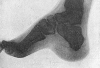 Fig. 151.—Radiogram of Foot of adult, showing the
changes in the bones in Pes Cavus.