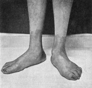 Fig. 152.—Adolescent Flat-foot.