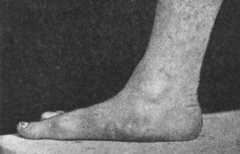 Fig. 153.—Flat-foot, showing loss of arch.