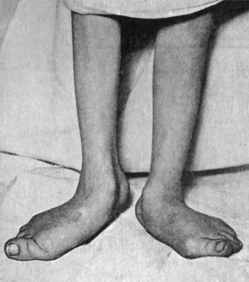 Fig. 155.—Bilateral Pes Valgus and Hallux Valgus in a
girl æt. 15, the result of Anterior Poliomyelitis.