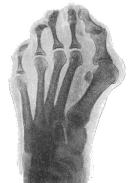 Fig. 157.—Radiogram of Hallux Valgus. The sesamoid
bone is seen displaced towards middle line of the foot.