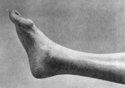 Fig. 159.—Hallux Rigidus and Flexus in a boy æt. 17.
There is a suppurating corn over the head of the first metatarsal
bone.
