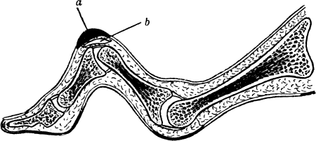 Fig. 161.—Section of Hammer-toe.