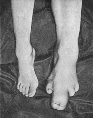 Fig. 162.—Congenital Hypertrophy of Left Lower
Extremity in a boy æt. 5. The second and third toes are fused.