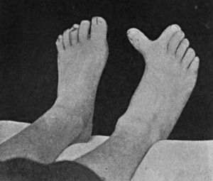 Fig. 163.—Supernumerary Great Toe.