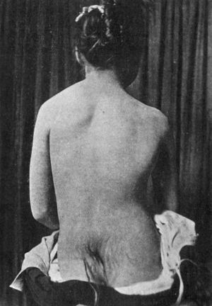 Fig. 164.—Congenital elevation of Left Scapula in a
girl: also shows hairy mole over Sacrum.