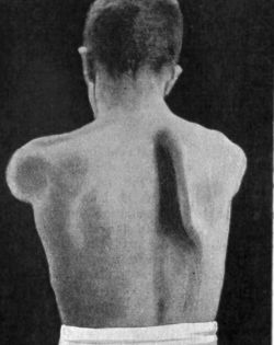 Fig. 165.—Winged Scapula; the patient is holding the
arms out in front.