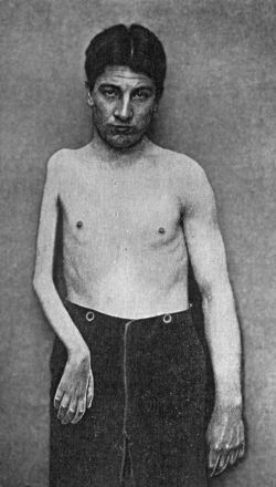 Fig. 166.—Arrested Growth and Wasting of Tissues of
Right Upper Extremity, the result of Anterior Poliomyelitis in
childhood.