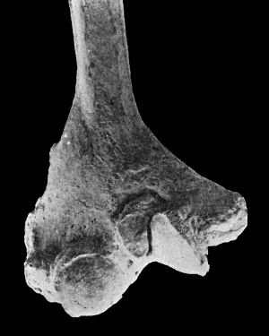 Fig. 167.—Lower end of Humerus from case of Cubitus
Varus.