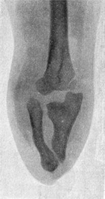 Fig. 169.—Radiogram of Arm of patient shown in Fig.
168.
